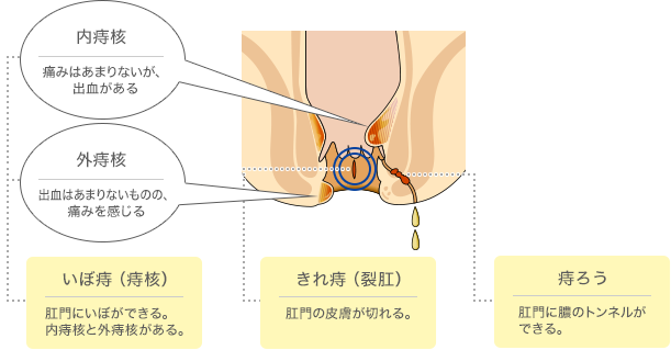 肛門疾患イメージ図