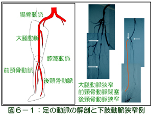 足の動脈解剖と下肢動脈狭窄例