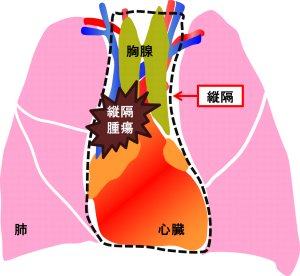 縦隔腫瘍イメージ図